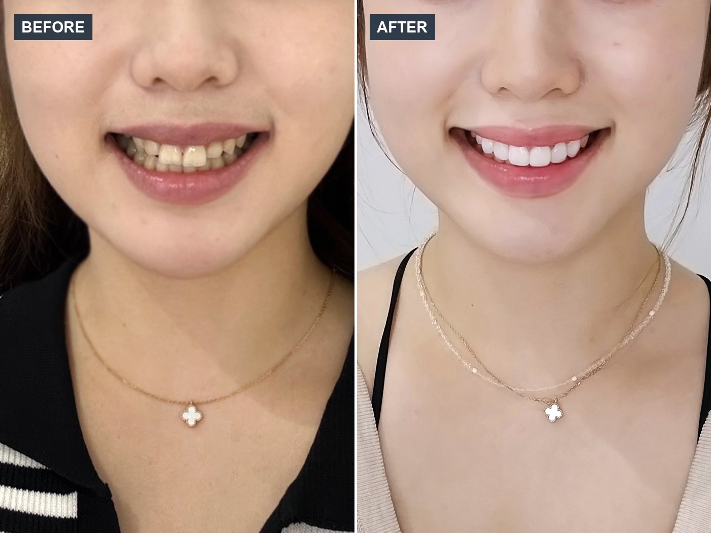 韓国 ラミネートベニア 審美歯科 症例 Before & After — Case 03