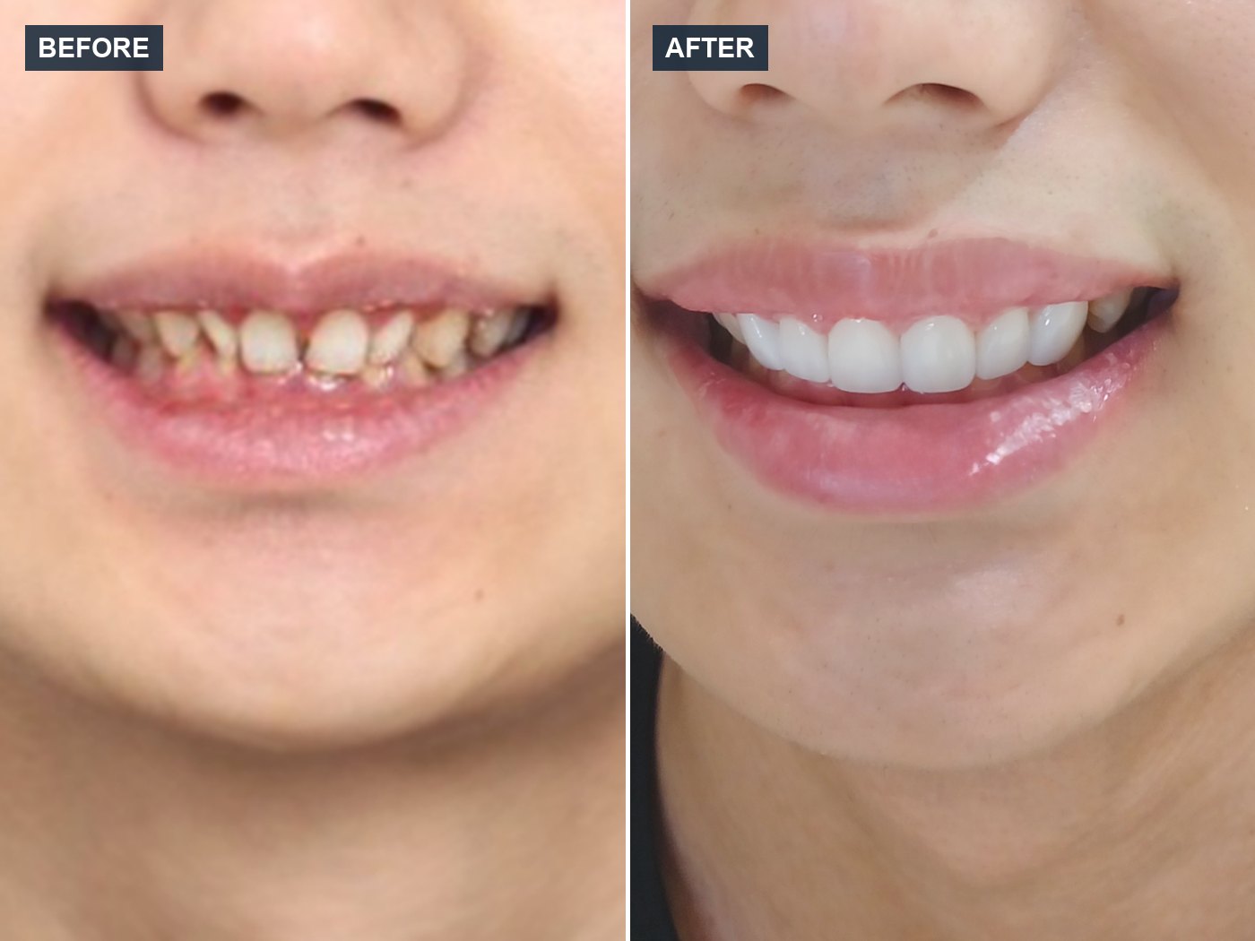韓国 ラミネートベニア 審美歯科 症例 Before & After — Case 08